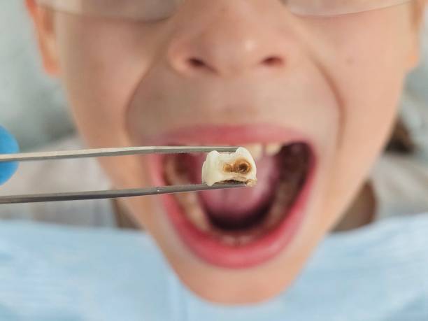 Best Dentist for Tooth Abscess  in Mitchell, IN